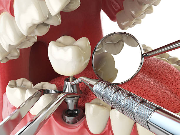 Best Dental Abscess Treatment in Luling, TX